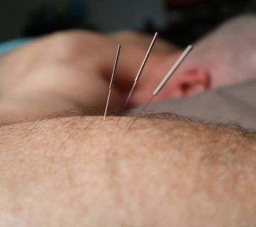 Elektro acupunctuur bij obstipatie